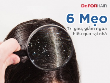 6 Mẹo Trị Gàu Ngứa Đầu Hiệu Quả Tại Nhà